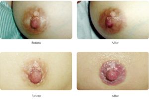 areola-before-after