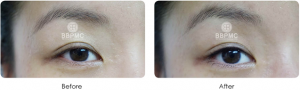 eyeline-before-after-5