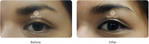 eyeline-before-after4