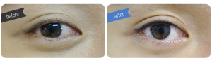 Eyeline Before & After