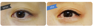 Eyeline Before & After
